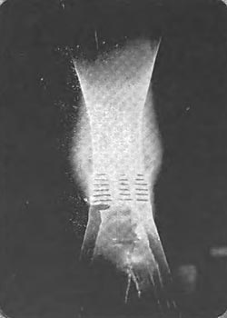 Fig. 11. � ONE OF THE LARGEST INSULATORS EVER BUILT, IN DISTRESS AT 175,000 VOLTS.