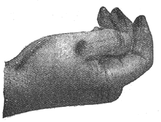 FIG. 4. DEATH OF FRANKLIN LEONARD POPE. � SHOWING BURNS ON HAND.